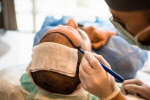 Hair Transplant in Islamabad