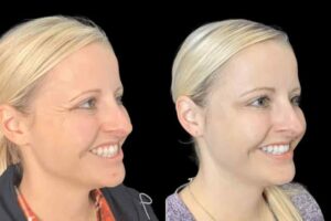 Choosing the Right Clinic for Botox in Dubai