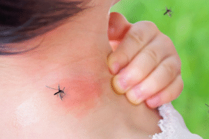 Doctor at Home for Insect Bites