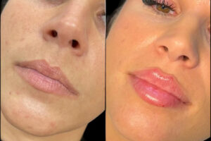fillers in Dubai