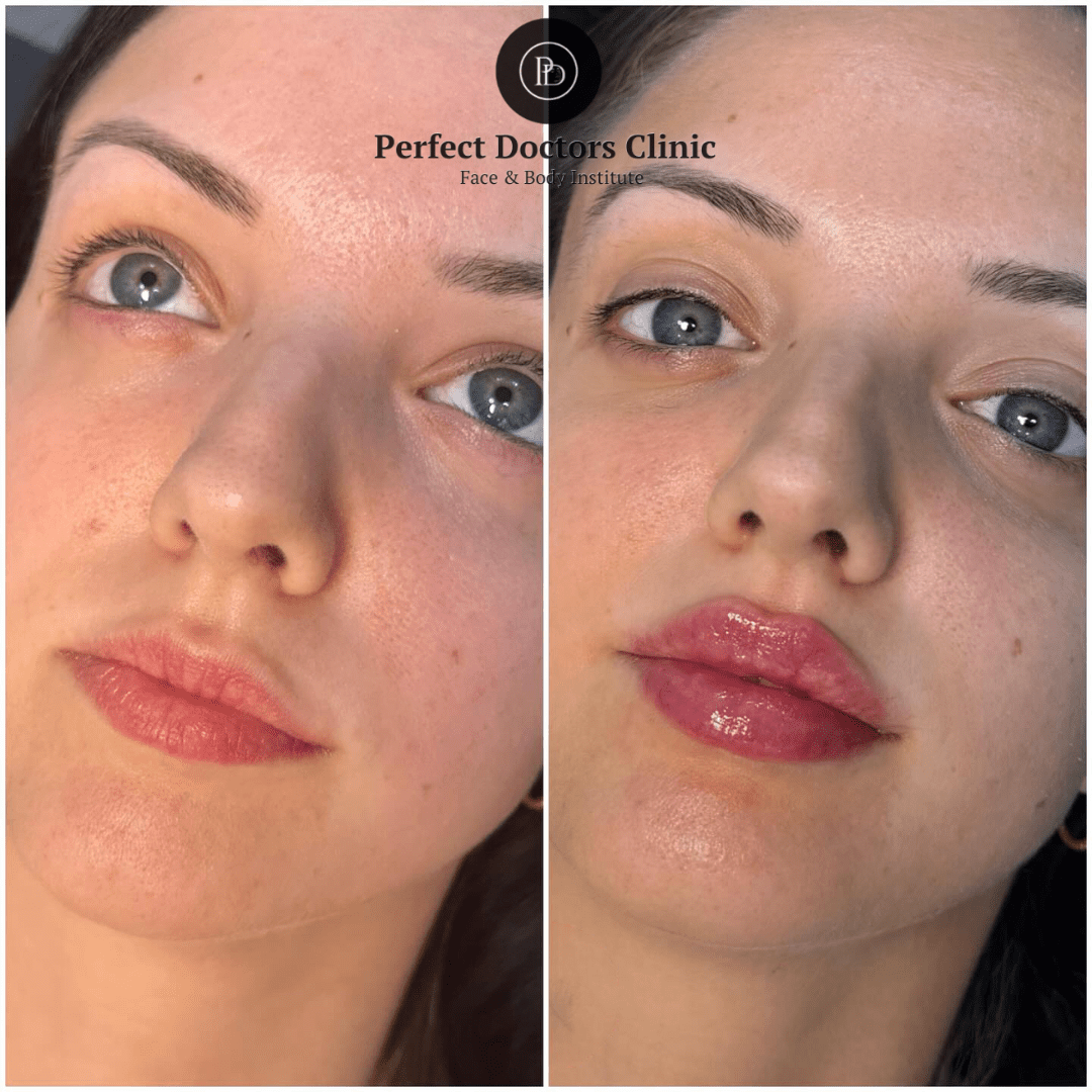Top 5 Reasons Why Juvederm Treatments in Dubai Are Highly Recommended