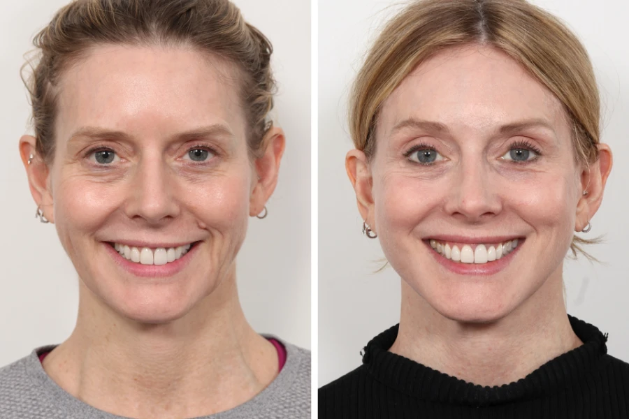 The Best Aesthetic Clinic in Dubai Offers Personalized Thread Lift Plans