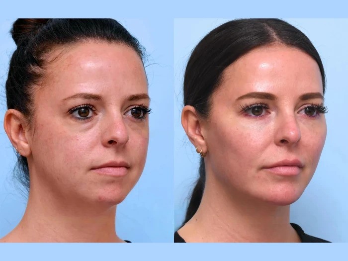 Enhance Your Features with Thread Lift at the Best Aesthetic Clinic in Dubai