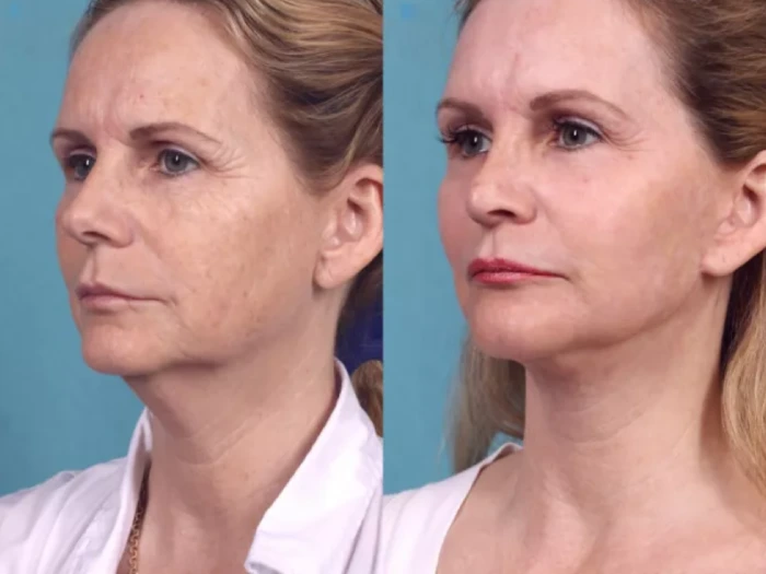 How to Prepare for Your Chemical Peel: Advice from the Best Plastic Surgeon in Dubai