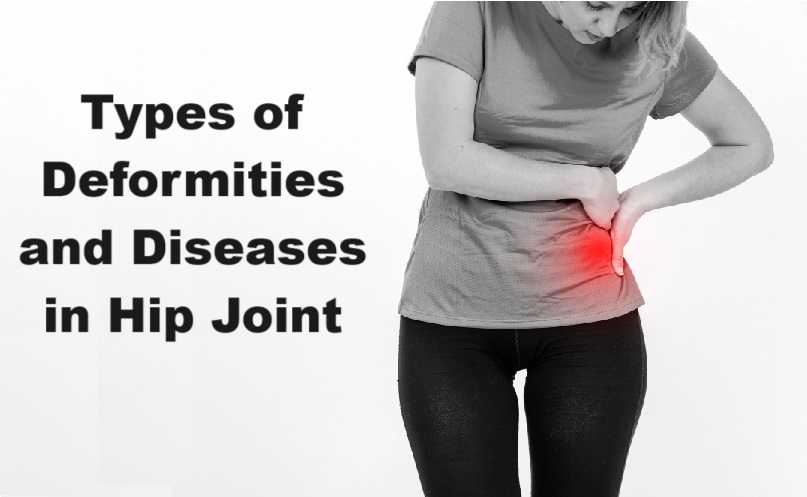 Types Of Deformities And Diseases In Hip Joint