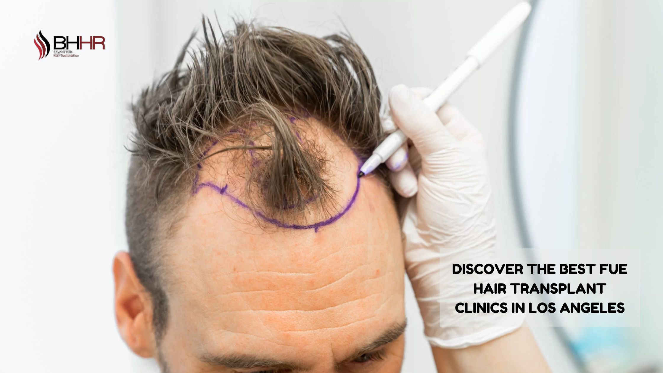 Discover the Best FUE Hair Transplant Clinics in Los Angeles