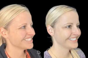 Look Refreshed with the Best Doctors in Dubai for Botox