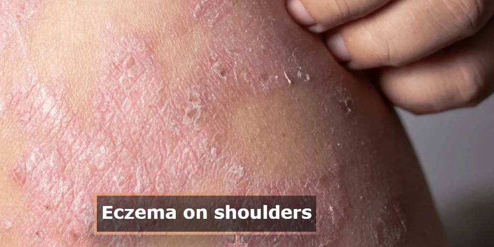 eczema