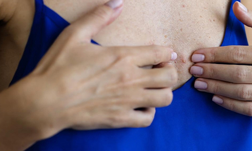 pimple on your breast