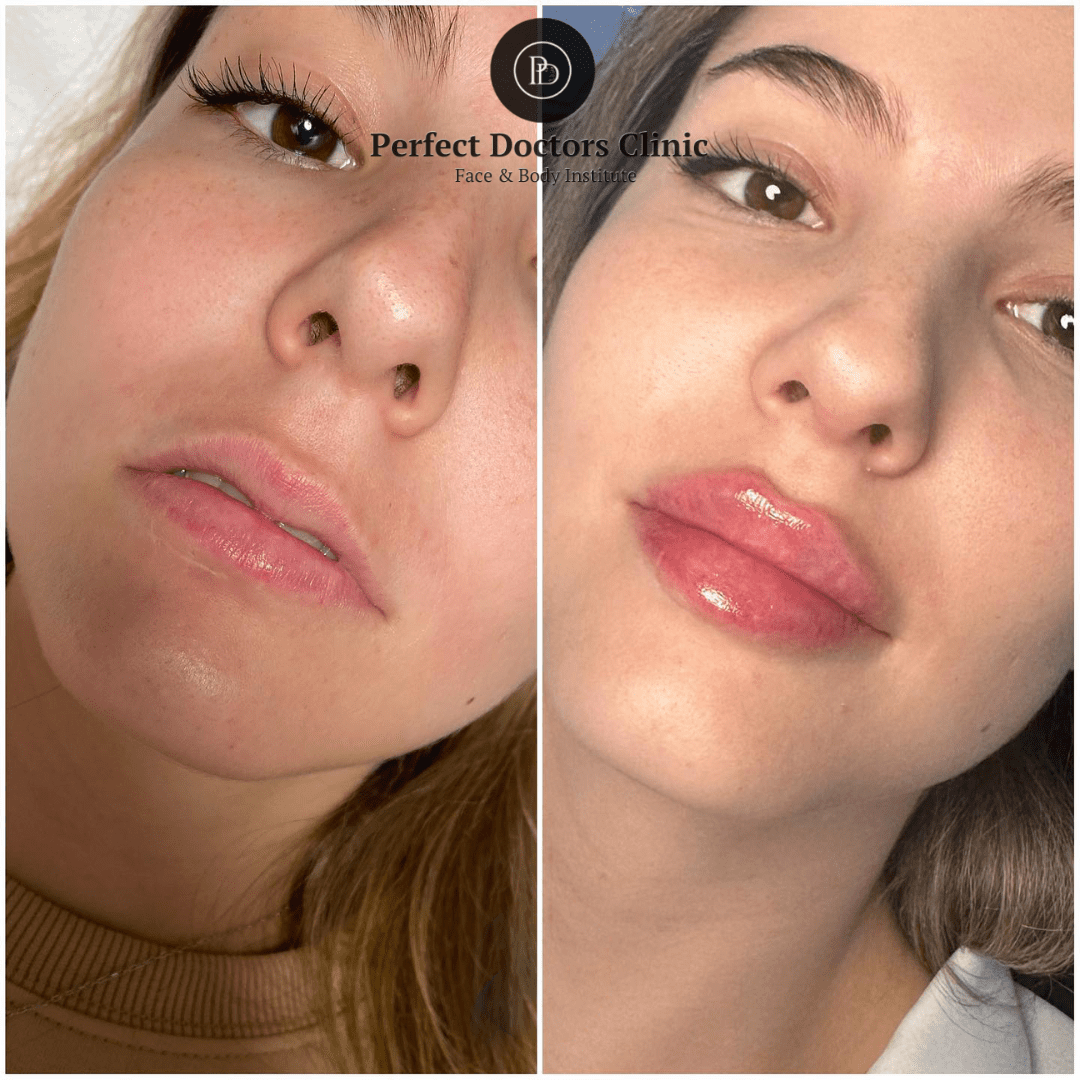 The Best Juvederm Treatments for a Natural-Looking Glow at the Best Aesthetic Clinics in Dubai