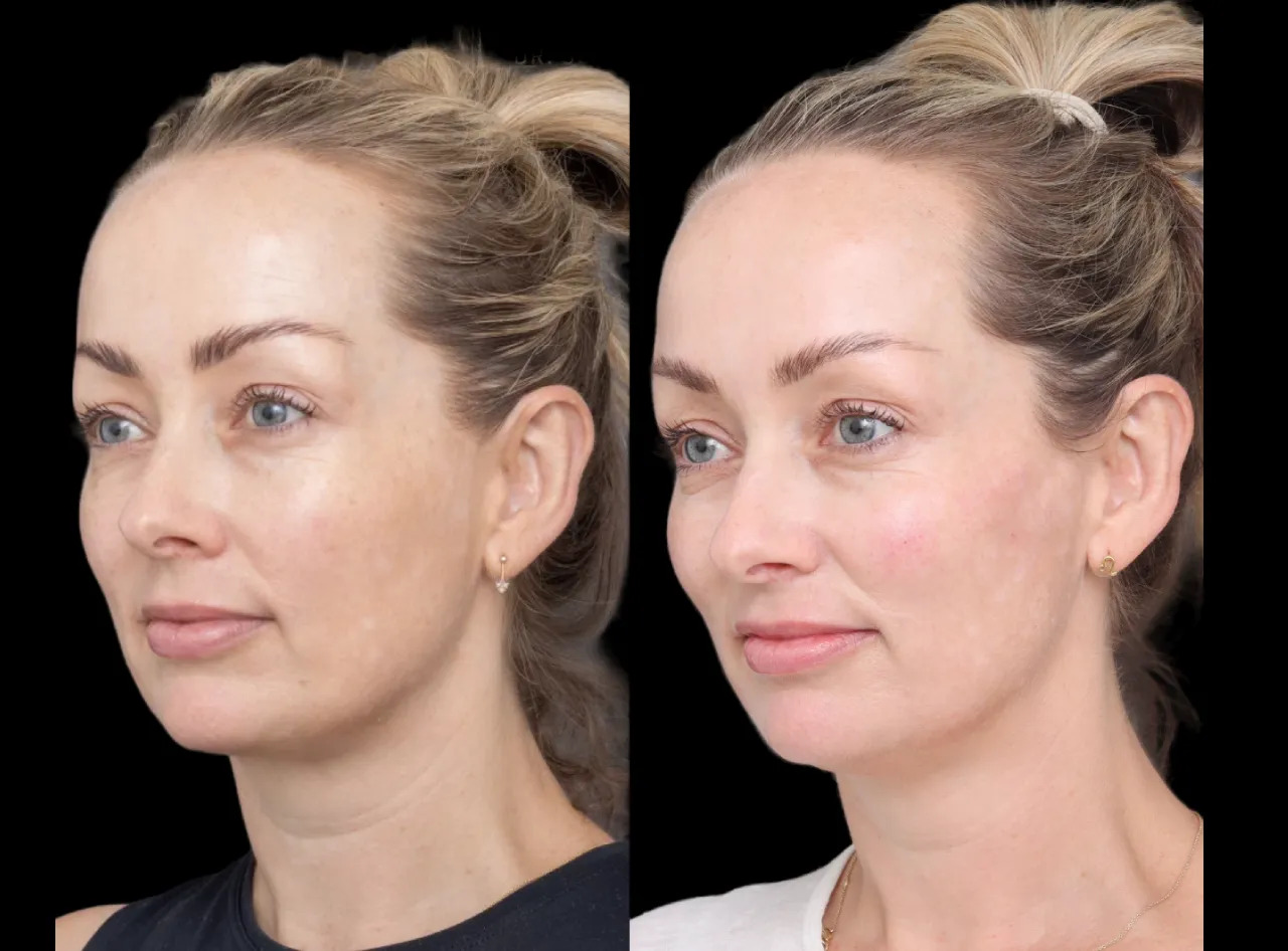 How to Achieve a Natural Look with Cheek Fillers in Dubai