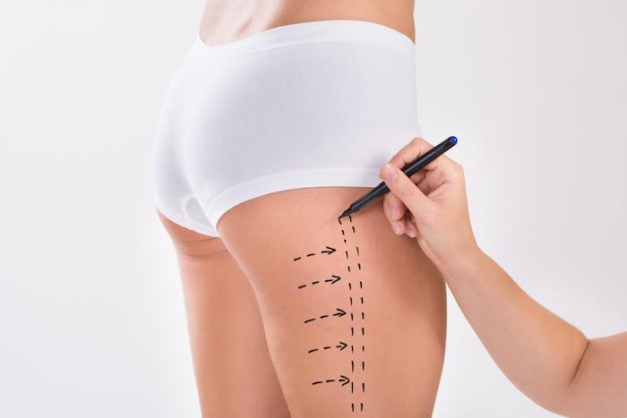 Your Reliable Guide to Choosing Top Liposuction Clinics in Dubai