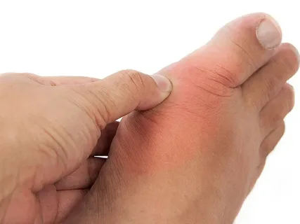 How to Relieve Big Toe Gout Pain with Simple Daily Steps