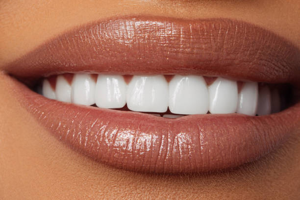 Teeth Whitening in Barrow