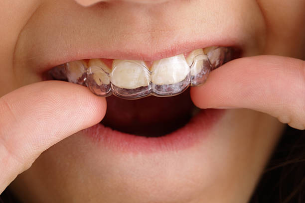 Invisalign for Teens in Aberdeen: The Clear Path to a Confident Smile