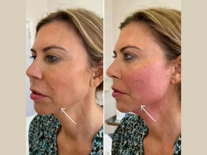 Endolift in Dubai for Double Chin Reduction: A Complete Guide
