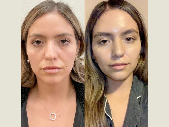 Reveal Youthful Contours Naturally Using Latest Thread Lift Treatment in Dubai