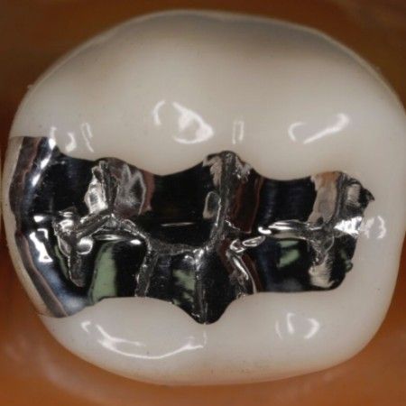 SMART – Dental Amalgam Removal