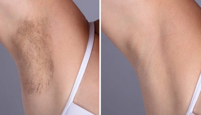 Best Aesthetic Clinics in dubai: Recommend FDA-Approved Laser Hair Removal