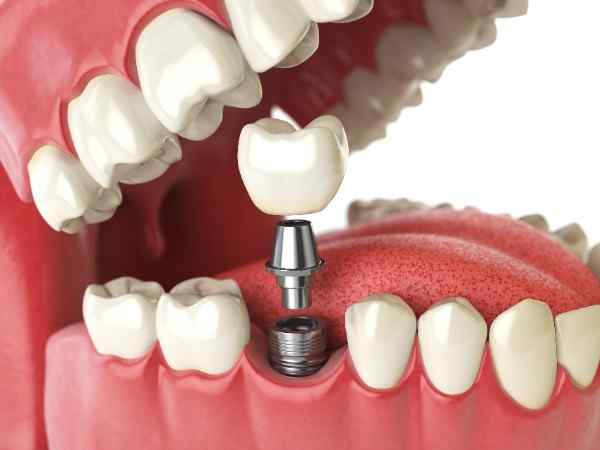dental implants Dunstable