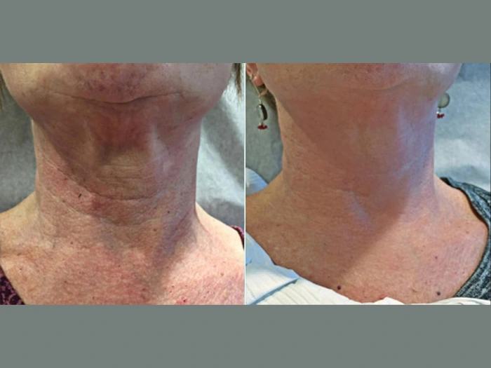Skin Tightening Treatment In Dubai
