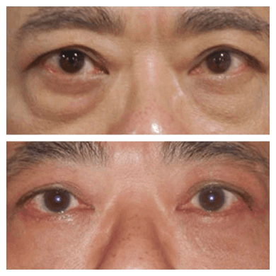 Eye bag removal in Dubai