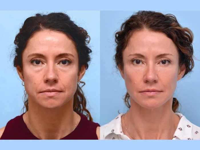 Best Aesthetic Clinics in Dubai Offers Seamless Thread Lift Face Enhancements