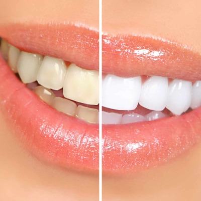 teeth whitening in islamabad